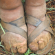 Caso de Podoconiosis. Wikimedia Commons